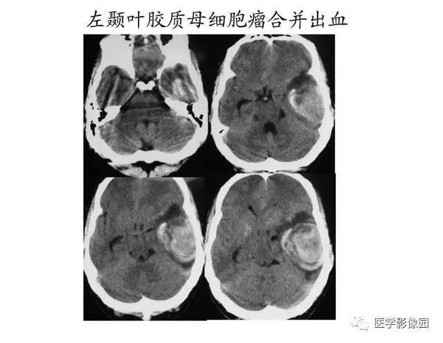 【PPT】脑肿瘤CT和MR诊断和鉴别诊断
