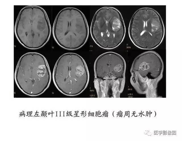 【PPT】脑肿瘤CT和MR诊断和鉴别诊断