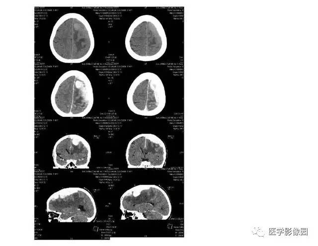 【PPT】脑肿瘤CT和MR诊断和鉴别诊断