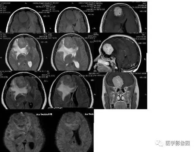 【PPT】脑肿瘤CT和MR诊断和鉴别诊断