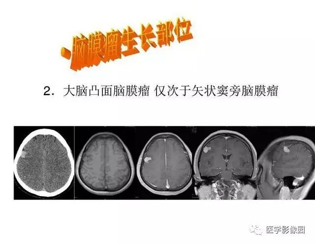 【PPT】脑肿瘤CT和MR诊断和鉴别诊断