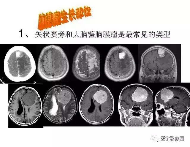 【PPT】脑肿瘤CT和MR诊断和鉴别诊断
