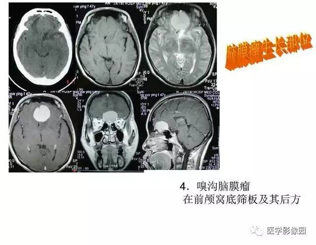 【PPT】脑肿瘤CT和MR诊断和鉴别诊断