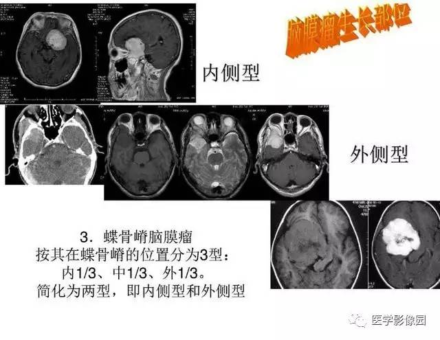 【PPT】脑肿瘤CT和MR诊断和鉴别诊断