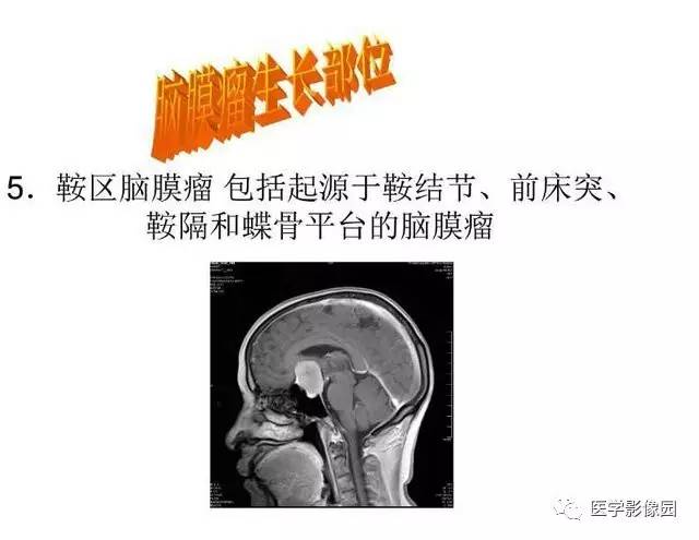 【PPT】脑肿瘤CT和MR诊断和鉴别诊断