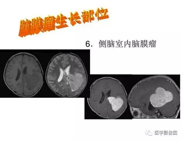 【PPT】脑肿瘤CT和MR诊断和鉴别诊断