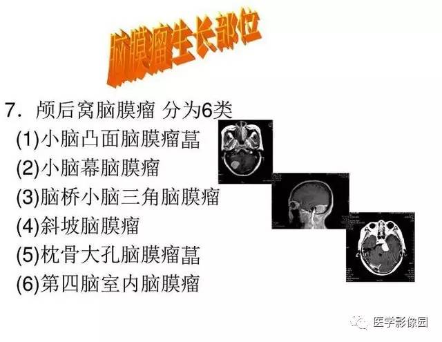 【PPT】脑肿瘤CT和MR诊断和鉴别诊断