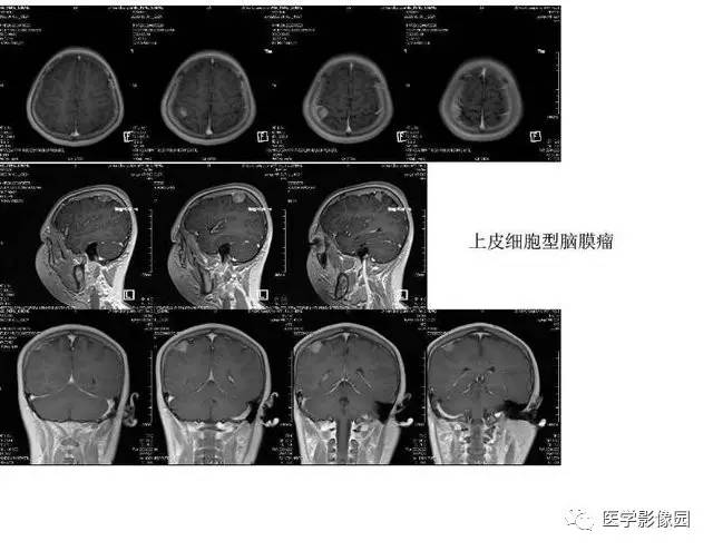【PPT】脑肿瘤CT和MR诊断和鉴别诊断