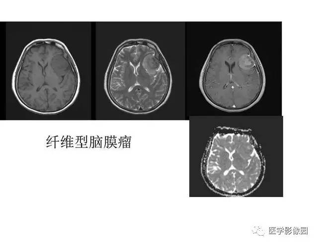 【PPT】脑肿瘤CT和MR诊断和鉴别诊断