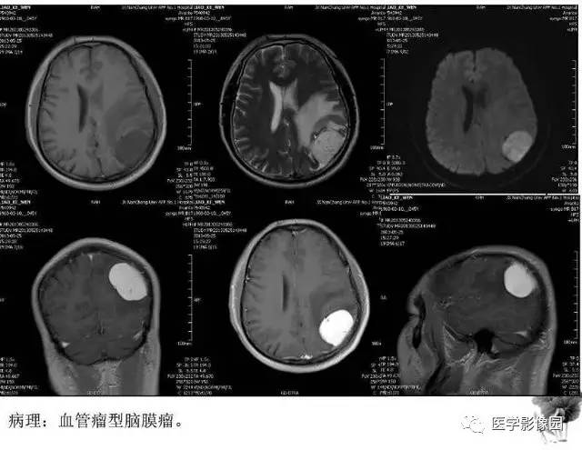 【PPT】脑肿瘤CT和MR诊断和鉴别诊断