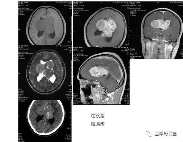 【PPT】脑肿瘤CT和MR诊断和鉴别诊断