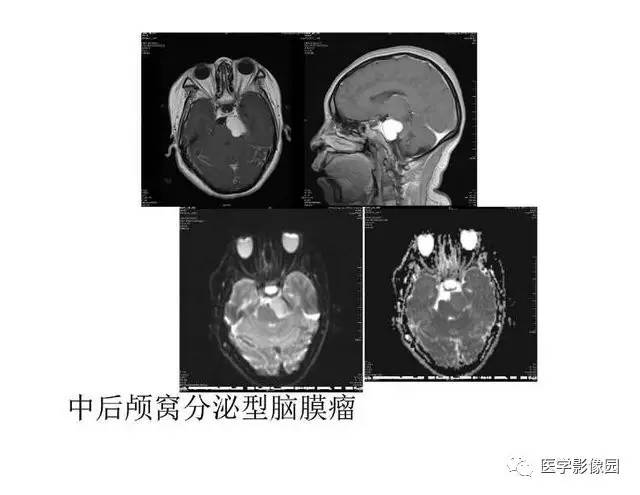 【PPT】脑肿瘤CT和MR诊断和鉴别诊断
