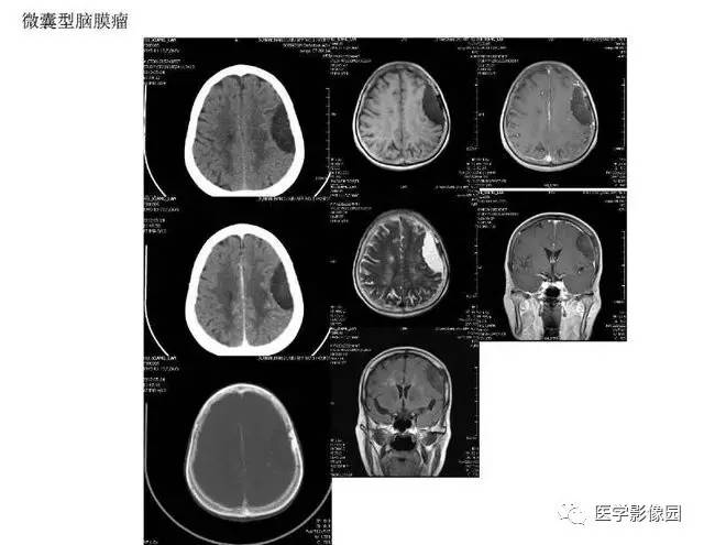 【PPT】脑肿瘤CT和MR诊断和鉴别诊断