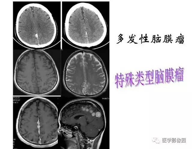 【PPT】脑肿瘤CT和MR诊断和鉴别诊断