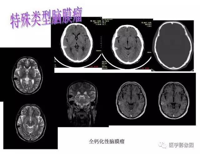 【PPT】脑肿瘤CT和MR诊断和鉴别诊断