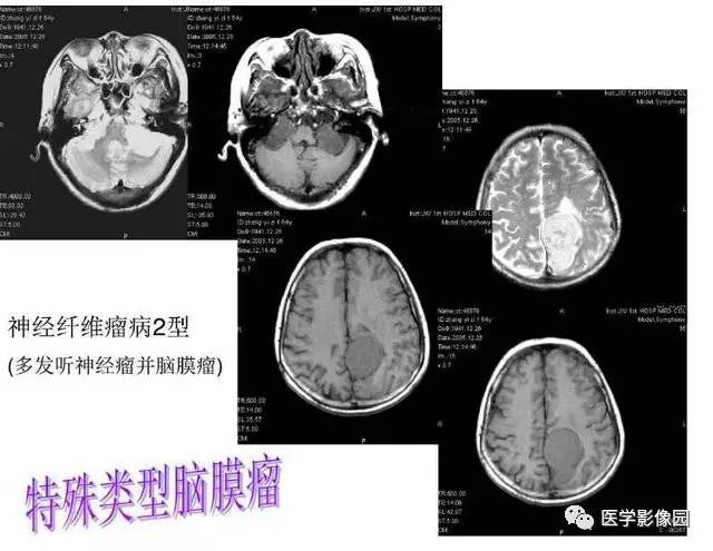 【PPT】脑肿瘤CT和MR诊断和鉴别诊断