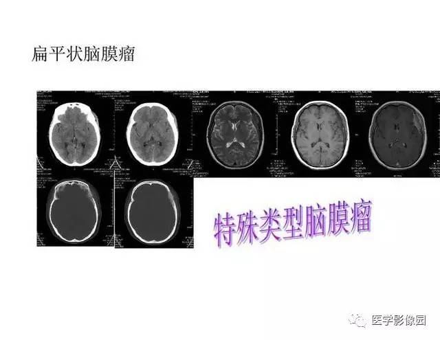 【PPT】脑肿瘤CT和MR诊断和鉴别诊断