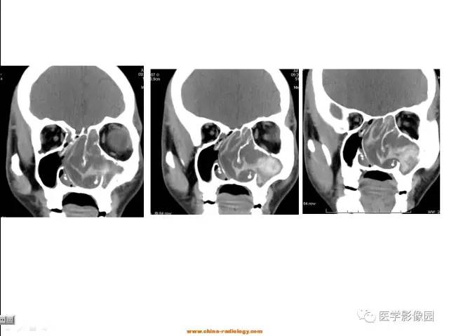 【病例】左鼻炎性息肉1例CT 【病例】左鼻炎性息肉1例CT