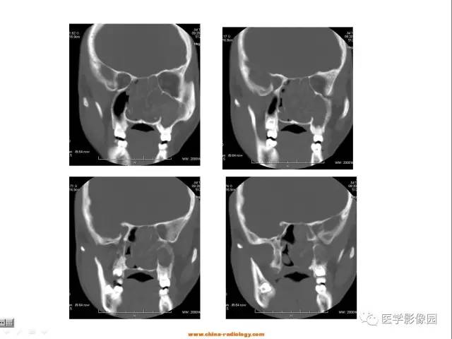 【病例】左鼻炎性息肉1例CT 【病例】左鼻炎性息肉1例CT