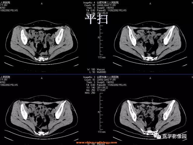 【病例】腹壁子宫内膜异位症1例CT影像表现 【病例】腹壁子宫内膜异位症1例CT影像表现