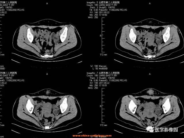 【病例】腹壁子宫内膜异位症1例CT影像表现 【病例】腹壁子宫内膜异位症1例CT影像表现