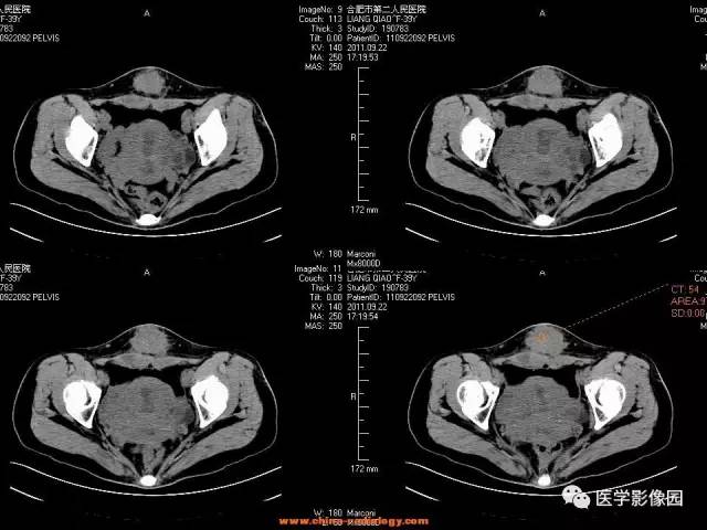 【病例】腹壁子宫内膜异位症1例CT影像表现 【病例】腹壁子宫内膜异位症1例CT影像表现