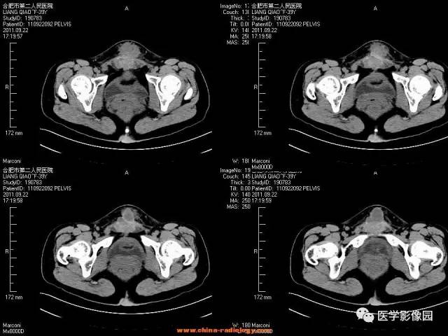 【病例】腹壁子宫内膜异位症1例CT影像表现 【病例】腹壁子宫内膜异位症1例CT影像表现