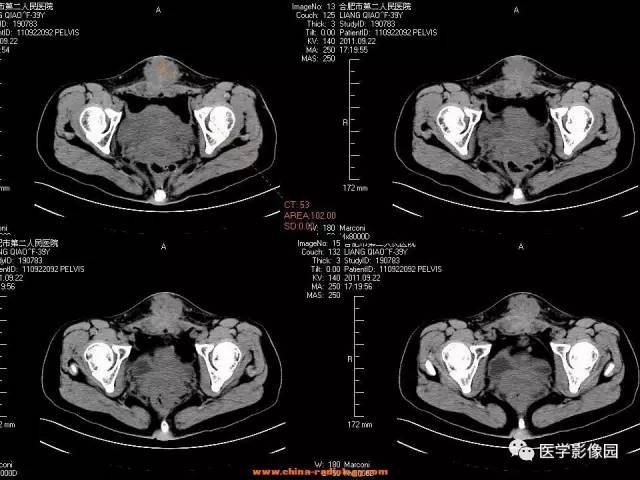 【病例】腹壁子宫内膜异位症1例CT影像表现 【病例】腹壁子宫内膜异位症1例CT影像表现