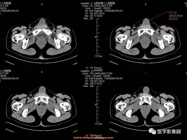 【病例】腹壁子宫内膜异位症1例CT影像表现 【病例】腹壁子宫内膜异位症1例CT影像表现