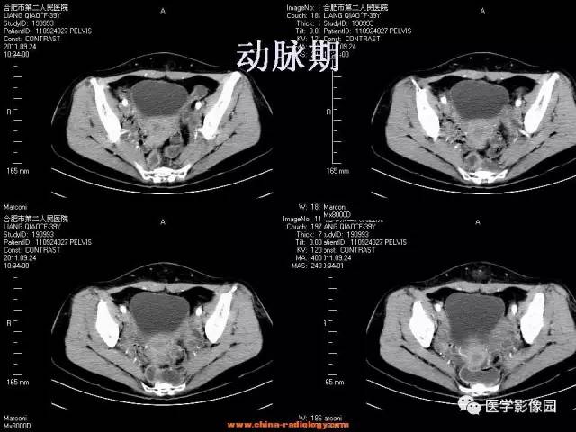 【病例】腹壁子宫内膜异位症1例CT影像表现 【病例】腹壁子宫内膜异位症1例CT影像表现