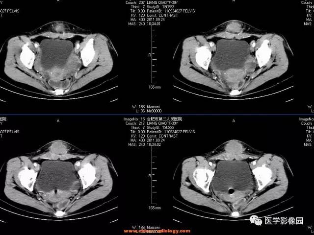 【病例】腹壁子宫内膜异位症1例CT影像表现 【病例】腹壁子宫内膜异位症1例CT影像表现