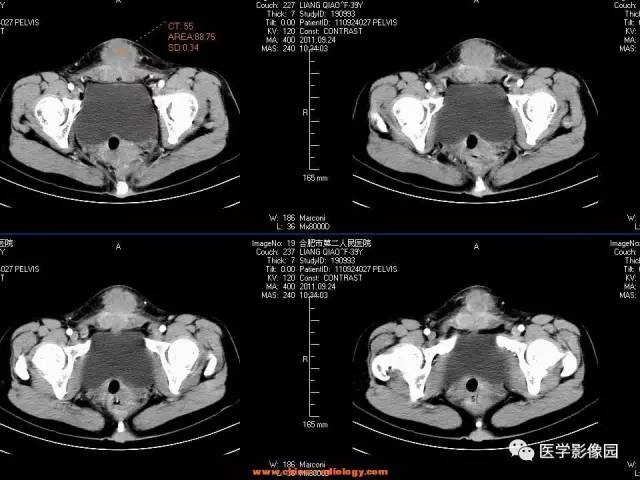 【病例】腹壁子宫内膜异位症1例CT影像表现 【病例】腹壁子宫内膜异位症1例CT影像表现