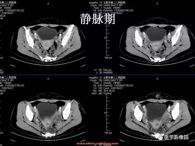 【病例】腹壁子宫内膜异位症1例CT影像表现 【病例】腹壁子宫内膜异位症1例CT影像表现