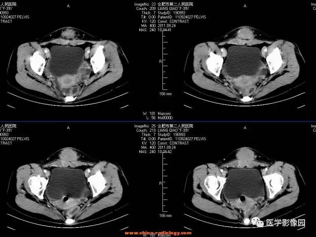 【病例】腹壁子宫内膜异位症1例CT影像表现 【病例】腹壁子宫内膜异位症1例CT影像表现