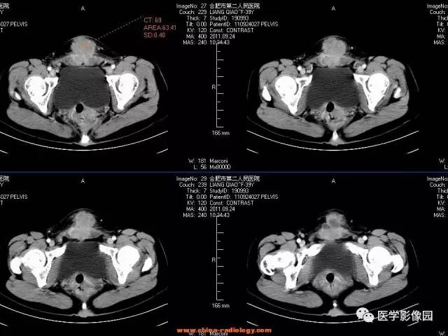 【病例】腹壁子宫内膜异位症1例CT影像表现 【病例】腹壁子宫内膜异位症1例CT影像表现