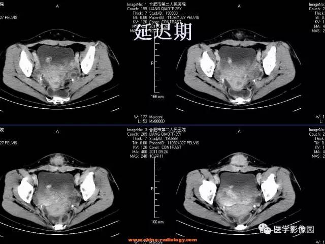 【病例】腹壁子宫内膜异位症1例CT影像表现 【病例】腹壁子宫内膜异位症1例CT影像表现