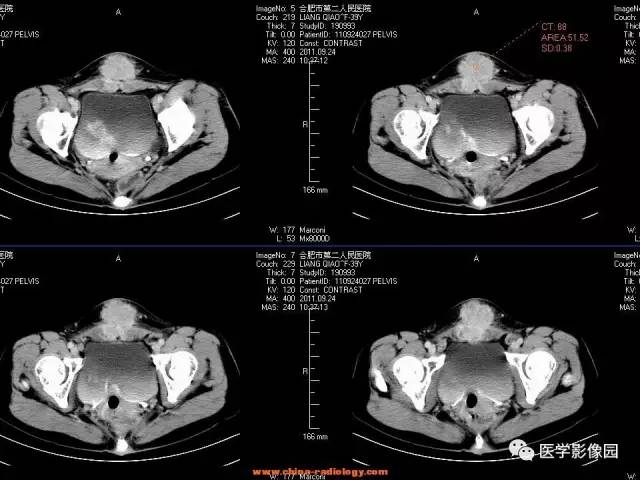 【病例】腹壁子宫内膜异位症1例CT影像表现 【病例】腹壁子宫内膜异位症1例CT影像表现
