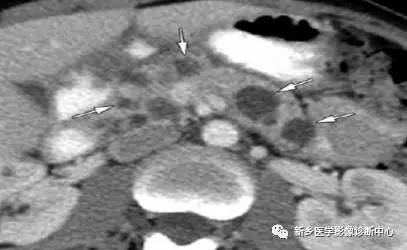 看到胰腺囊性密度/信号,要想到的17种病变 看到胰腺囊性密度/信号,要想到的17种病变