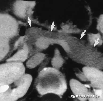 看到胰腺囊性密度/信号,要想到的17种病变 看到胰腺囊性密度/信号,要想到的17种病变