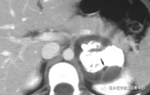 看到胰腺囊性密度/信号,要想到的17种病变 看到胰腺囊性密度/信号,要想到的17种病变