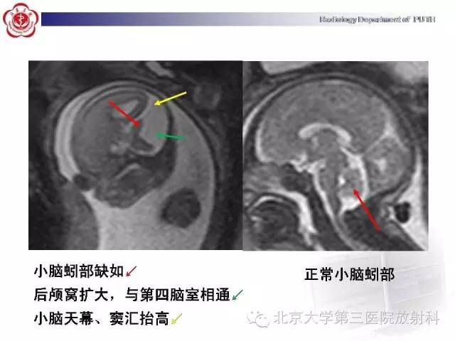 【病例】Dandy-Walker综合征1例MR影像诊断