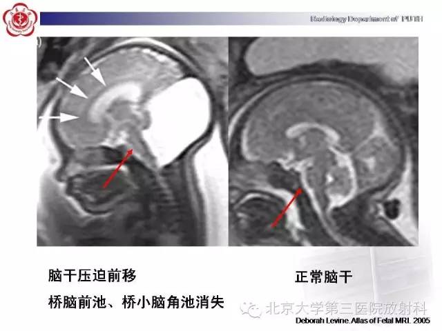 【病例】Dandy-Walker综合征1例MR影像诊断