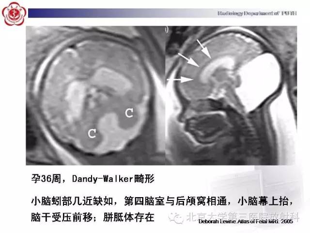 【病例】Dandy-Walker综合征1例MR影像诊断