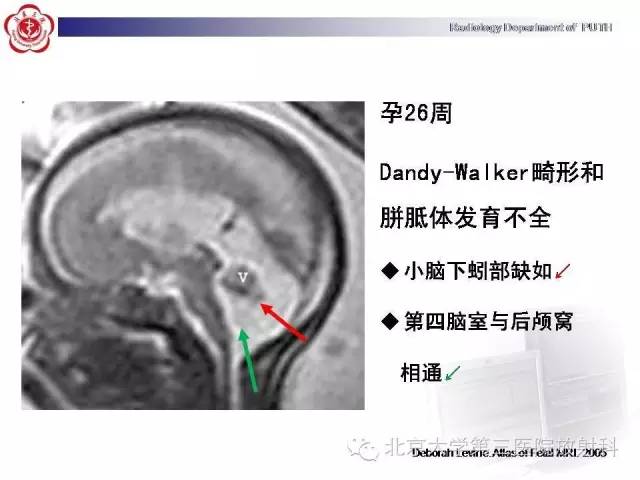 【病例】Dandy-Walker综合征1例MR影像诊断