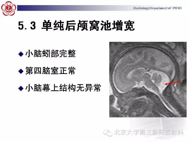 【病例】Dandy-Walker综合征1例MR影像诊断