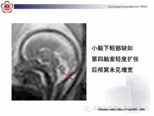 【病例】Dandy-Walker综合征1例MR影像诊断