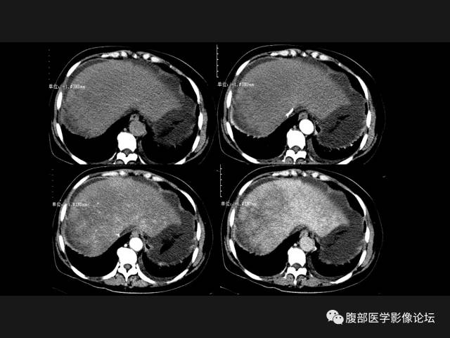 【病例】肝窦阻塞综合征HSOS一例CT及MR