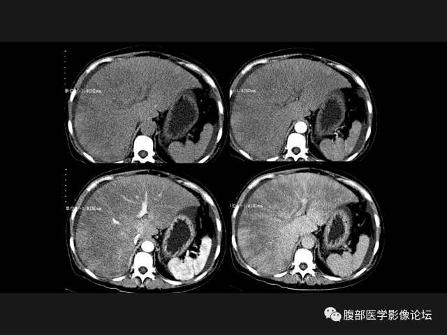 【病例】肝窦阻塞综合征HSOS一例CT及MR
