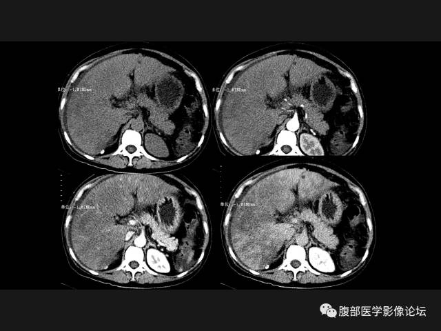 【病例】肝窦阻塞综合征HSOS一例CT及MR