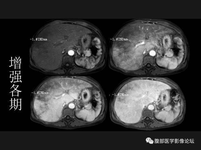 【病例】肝窦阻塞综合征HSOS一例CT及MR